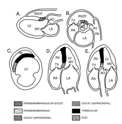 Ventricular Septal Defect Vsd Echopedia