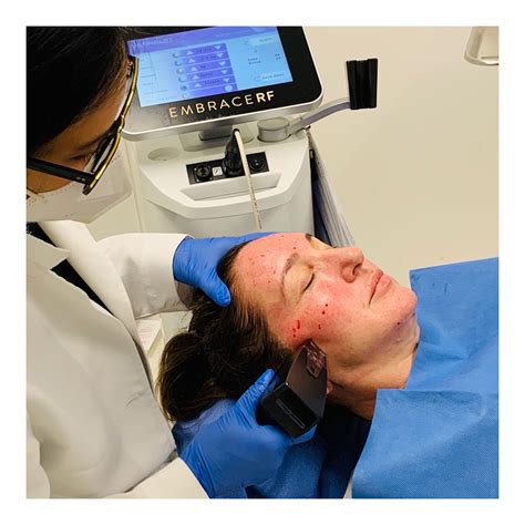 Microneedling Beverly Hills | Julie Edween D.O.