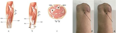 A Forearm Palmar View Before Mrt B Forearm Palmar View After Mrt