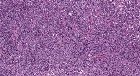 Follicular T cell lymphoma | Ottawa Atlas of Pathology