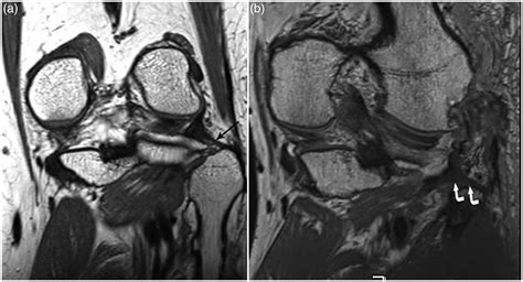 Popliteofibular Ligament Mri