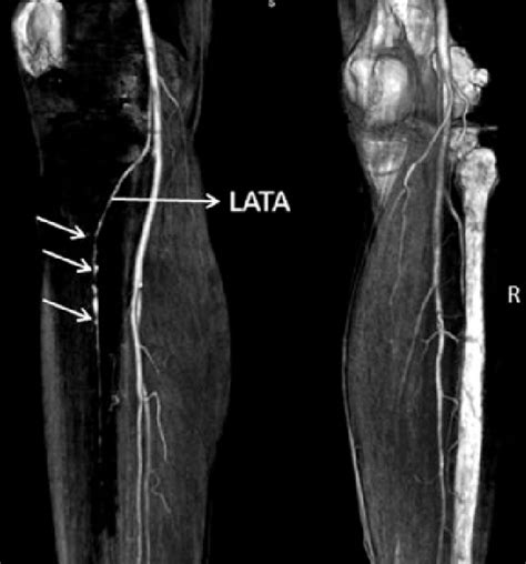 Anterior Tibial Arteries