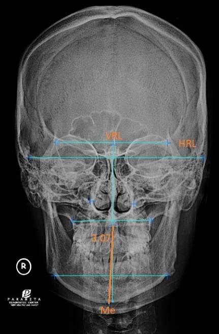 Skull Pa Analysis Using Orthovision Program 307° Deviating To The