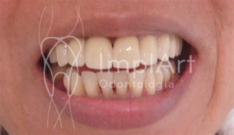 Implante De Dente Boca Toda Cl Nica Odontol Gica De Implante Dent Rio