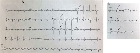 Referring hospital 12-lead ECG. A Arrows display anteroseptal (V2–V4)... | Download Scientific ...