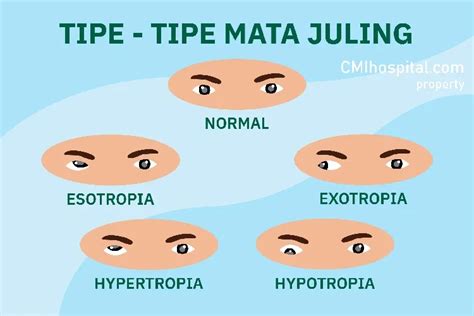 Umum Strabismus Kelainan Mata Yang Jangan Disepelekan Cmihospital