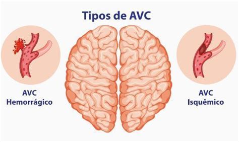 Avc Embolia Mind Map