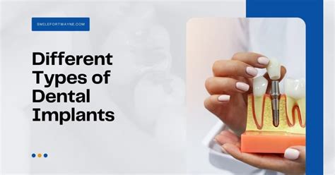 6 Different Types of Dental Implants