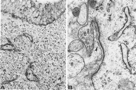 Human Endometrial Biopsy Specimens With Hyperplasia A Adenomatous