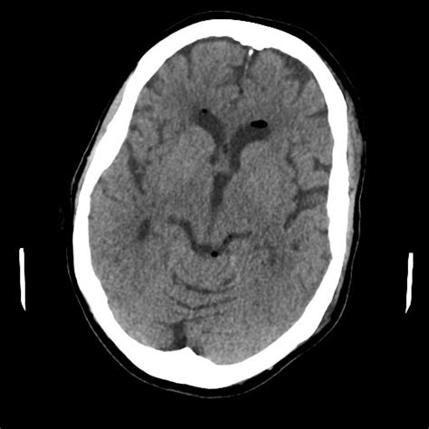 Ruptured Intracranial Dermoid Cyst Image