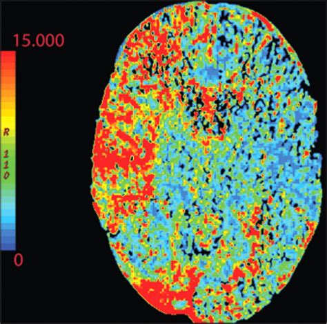 Imaging Of Stroke Part Perfusion Ct Overview Of Imaging Technique