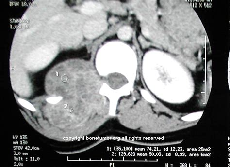 Aneurysmal Bone Cyst - spine | BoneTumor.org