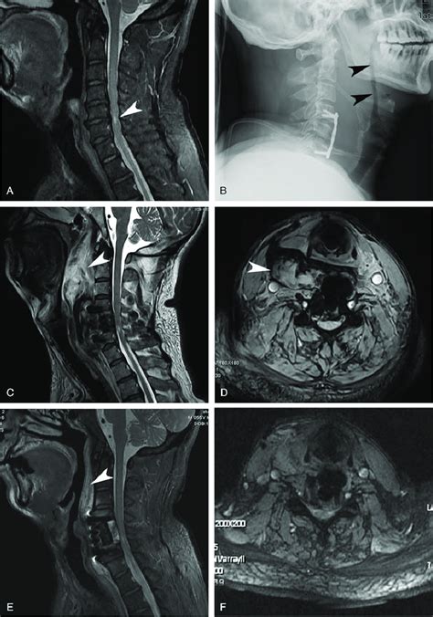 Sagittal cervical spine MRI (A) showing large C4/5 and C5/6 disc ...