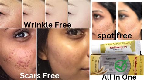 अब दाग और गढ़े जड़ से खत्म Aziderm Cream Review Azelaic Acid Aziderm Cream 10 Aziderm 10