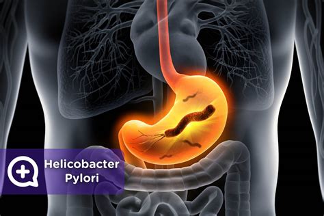 Helicobacter Pylori La Bacteria Que Ataca Al Estómago Mediquo