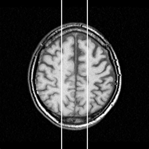 extraction   midsagittal plane shown   slices