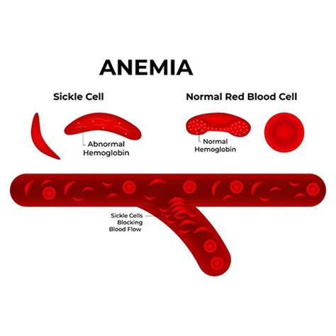 Anemia in children : Causes, Symptoms, Diagnosis, Treatment and ...