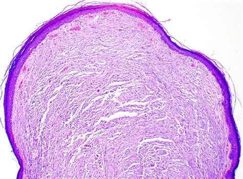Palisaded Encapsulated Neuroma (PEN): An often misdiagnosed neural tumor