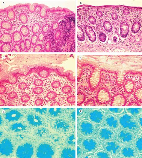 Hematoxylin Eosin And Alcian Blue Staining Of The Rectal Mucosa