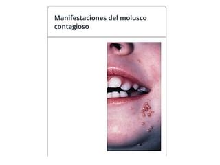 Virus Del Molusco Contagioso PPT