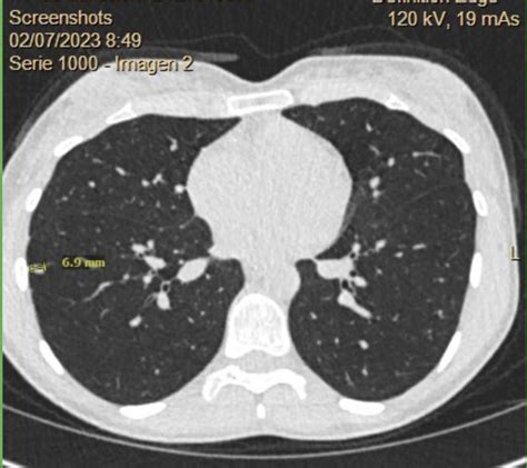 Lung Nodules on CT Scan? : r/AskDocs