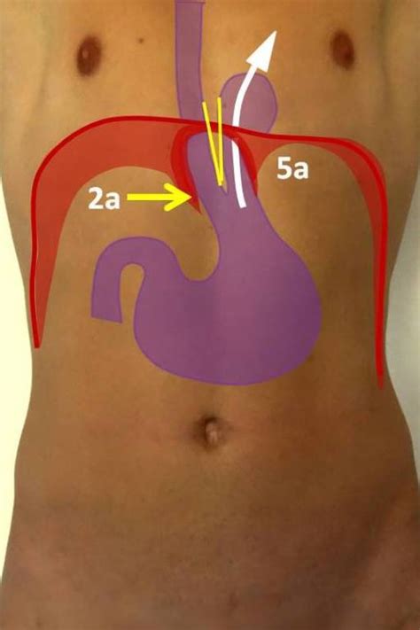 Reflux Op Und Zwerchfellbruch Op In N Rnberg Klinik Hallerwiese De