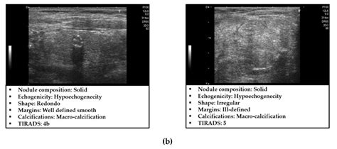 Benign Thyroid Nodules