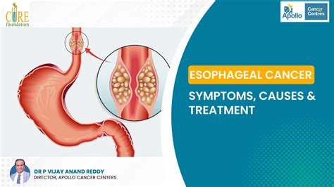 Esophageal Cancer Symptoms Causes And Treatment Dr Vijay Anand Reddy