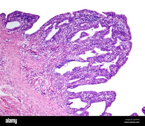 Chronic Salpingitis Light Micrograph Stock Photo Alamy