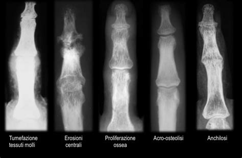 Artrite Psoriasica Semeiotica Delle Lesioni Elementari In Radiologia