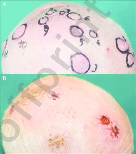 Recurrences Of Scalp Squamous Cell Carcinoma At Right Download Scientific Diagram