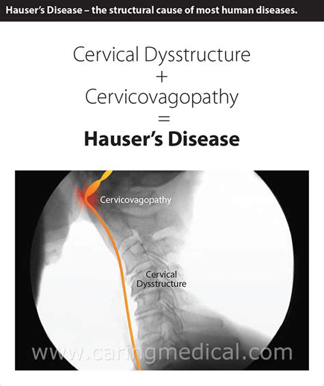 Determining The Causes Of Dysautonomia Vagopathy And Autonomic