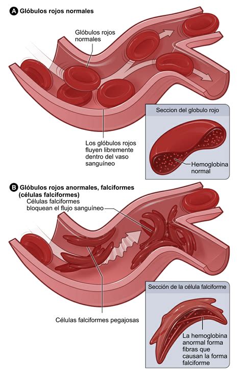 Anemia De C Lulas Falciformes Nhlbi Nih