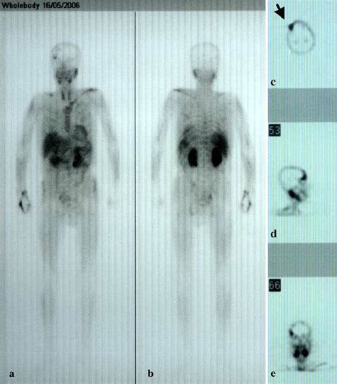 Anterior A And Posterior B Whole Body Sestamibi Scans Of