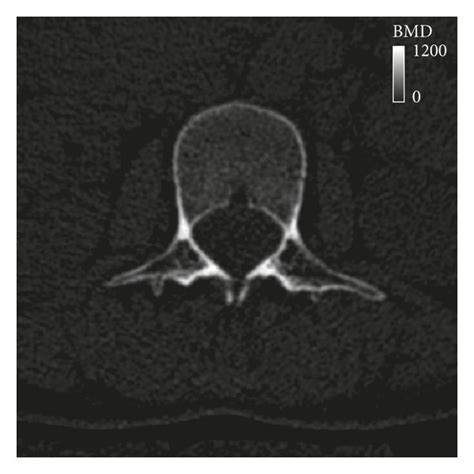 Bmd Contour Plot At The Axial Level Of The L Vertebra A The