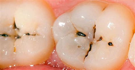 How To Tell The Difference Between Cavities And Stains Key Differences