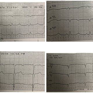 Electrocardiogram at admission. Initial laboratory results were as... | Download Scientific Diagram