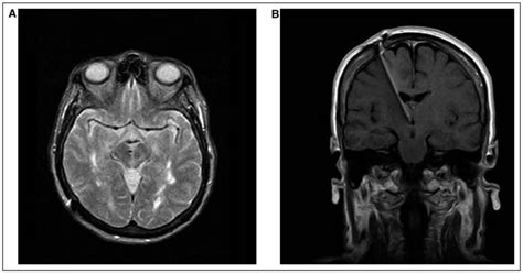 Trigeminal Neuralgia Mri Scan