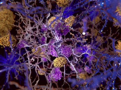 Alzheimers How Does Tau Disrupt Brain Cells