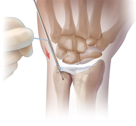 Arthrex - Arthroscopic TFCC Repair