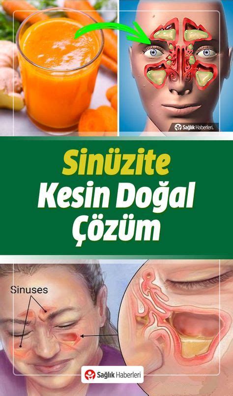 Sinüzit Belirtileri Nelerdir Neden Olur Ne İyi Gelir Sinüzit Doğal