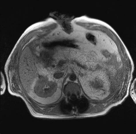 T Weighted In Phase Sequence Axial Mri The Pancreas Is Again