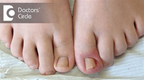 How To Manage Ingrown Toenail Dr Amee Daxini Youtube