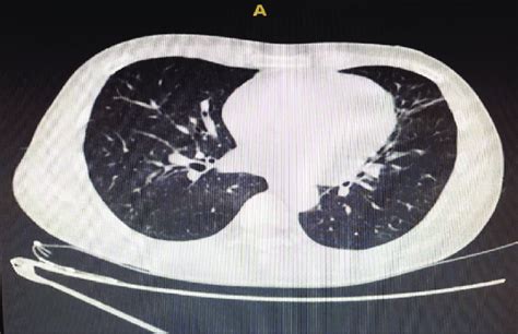 Non Contrast Thoracic Ct Yellow Arrow Showing Pulmonary Fibrosis