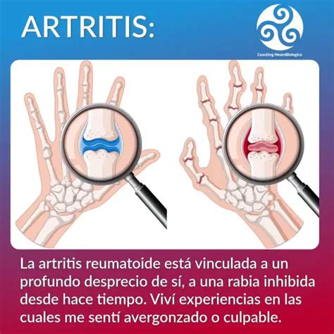 Biodescodificaci N De La Artritis Coaching De Salud Integral