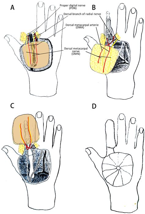 Clinical Application Of An Expanded Reverse Island Flap With Two Dorsal