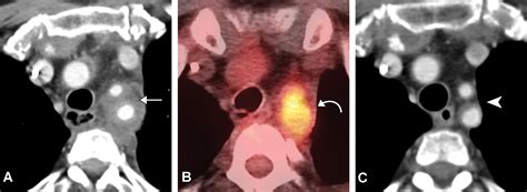 Subclavian Artery Anatomic Review And Imaging Evaluation Of Abnormalities Radiographics