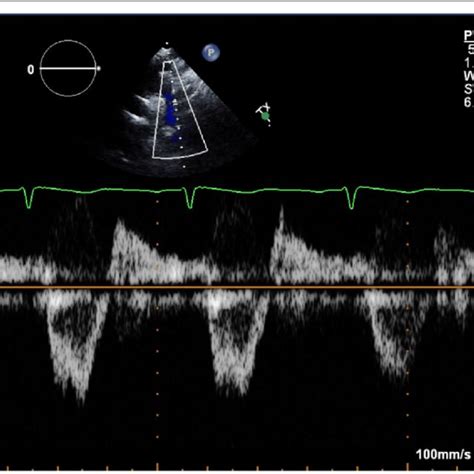 Transthoracic Echocardiography Suprasternal View With Pulsed Doppler