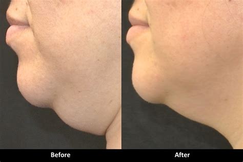 Kybella Before And After Pictures Med Spa In Encino Ca A E Skin