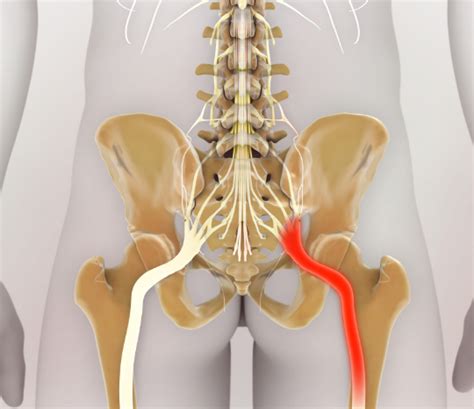 Sciatica Treatment In Tampa FL Frontier Physical Medicine